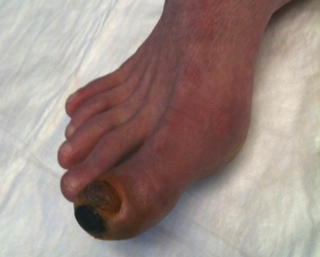 Frostbite: Dead skin resolving at tip of big toe.