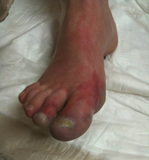 Frostbite on foot, five days after injury.