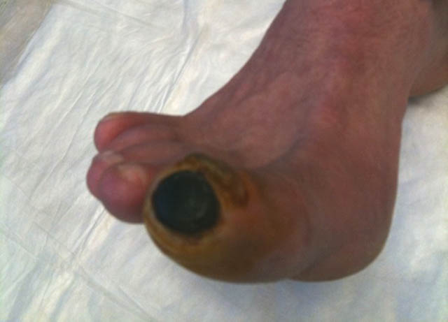 Frostbite: Large cap of dead skin at tip of right toe.