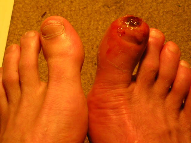 Difference between feet after seven months healing frostbite