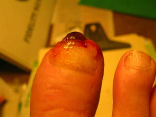 Dead skin over bone at the tip of my toe.