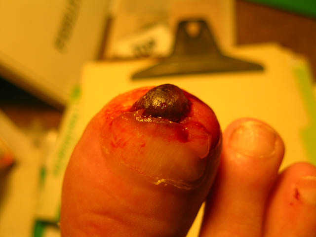 Top view of dead skin covering bone at the end of my right big toe.